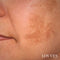 Depigmentierendes Gesichtsflecken-Aufhellungsserum
